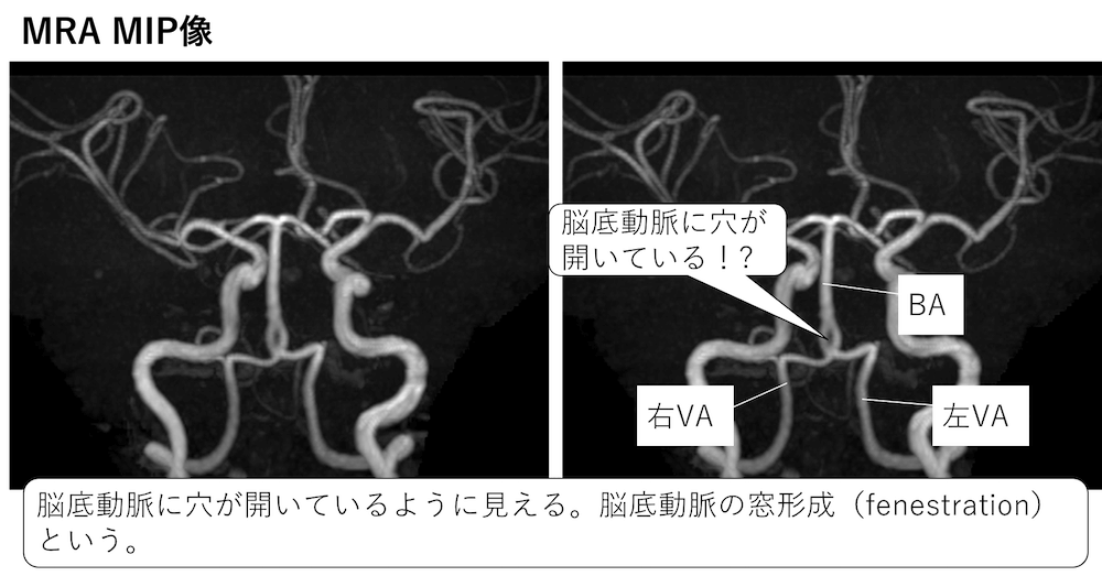 脳のMRAにおける脳底動脈の窓形成（fenestration）とは？